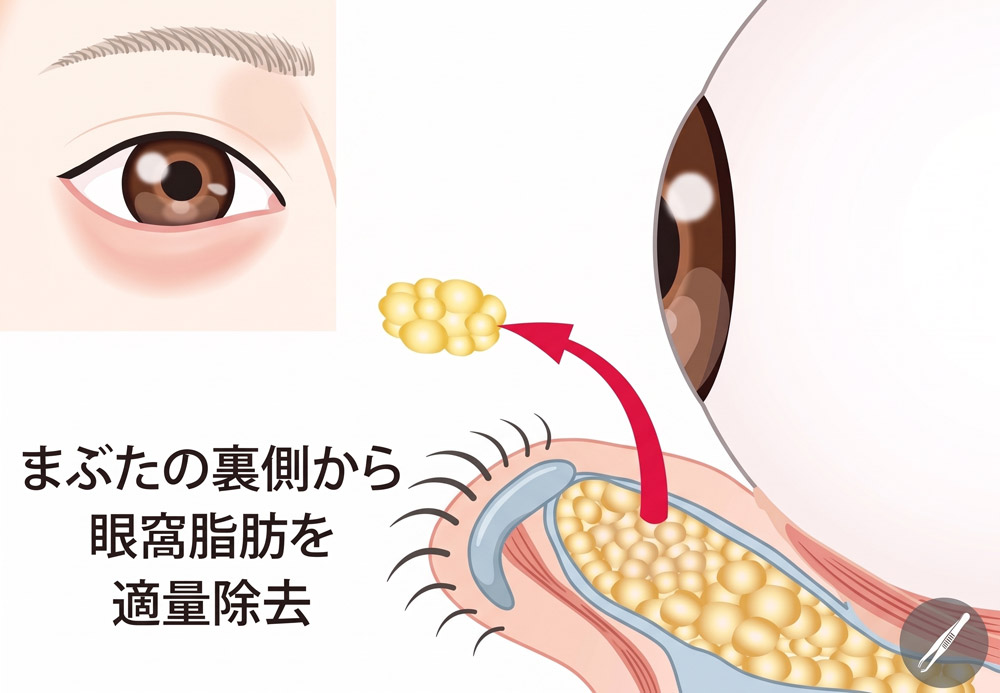 経結膜脱脂術の施術イメージ